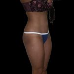 Liposuction Female Before & After Patient #2751