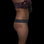 Liposuction Female Before & After Patient #2751
