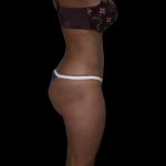 Liposuction Female Before & After Patient #2751