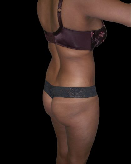 Liposuction Female Before & After Patient #2751