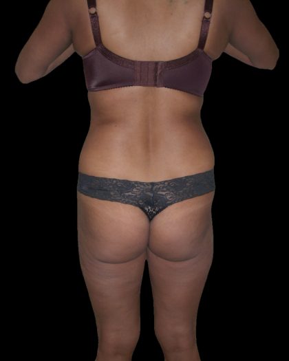 Liposuction Female Before & After Patient #2751