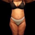 Liposuction Female Before & After Patient #2752