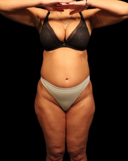 Liposuction Female Before & After Patient #2752