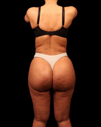 Liposuction Female Before & After Patient #2752