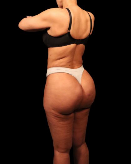 Liposuction Female Before & After Patient #2752