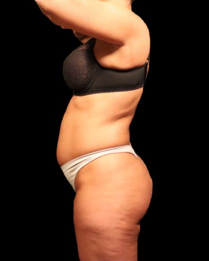 Liposuction Female Before & After Patient #2752