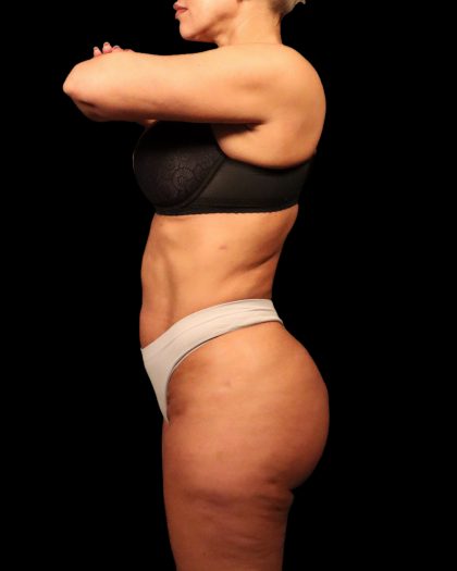 Liposuction Female Before & After Patient #2752