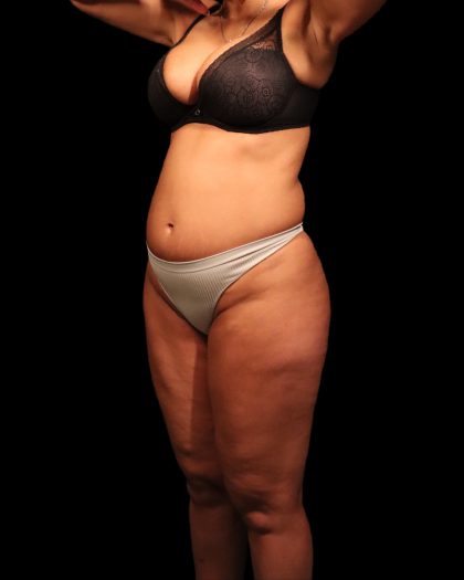 Liposuction Female Before & After Patient #2752