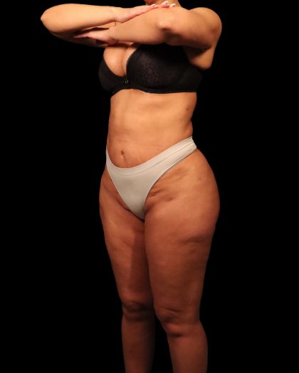 Liposuction Female Before & After Patient #2752