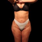 Liposuction Female Before & After Patient #2752