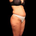 Liposuction Female Before & After Patient #2752
