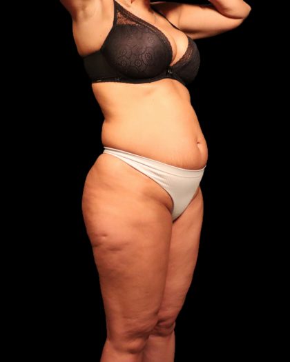 Liposuction Female Before & After Patient #2752