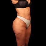 Liposuction Female Before & After Patient #2752