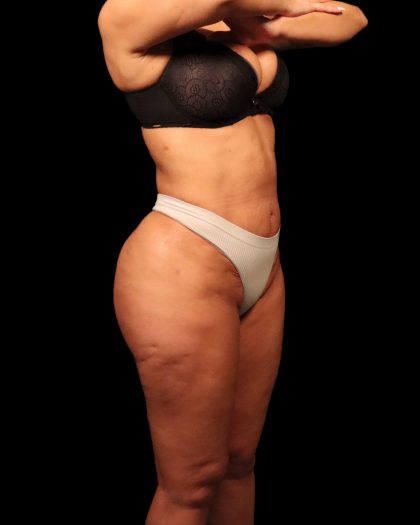 Liposuction Female Before & After Patient #2752