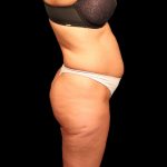 Liposuction Female Before & After Patient #2752