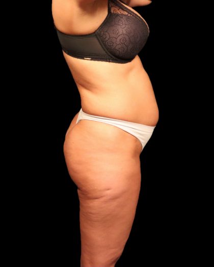 Liposuction Female Before & After Patient #2752