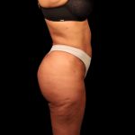 Liposuction Female Before & After Patient #2752