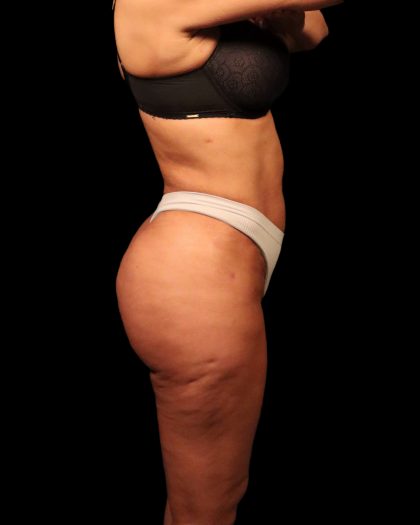 Liposuction Female Before & After Patient #2752