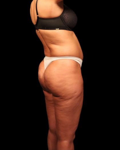 Liposuction Female Before & After Patient #2752