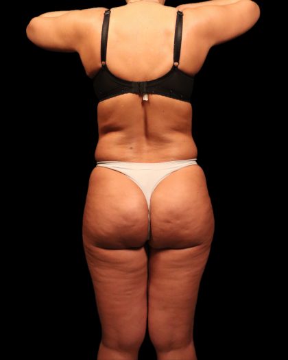 Liposuction Female Before & After Patient #2752