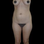 Liposuction Female Before & After Patient #2739