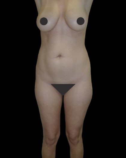 Liposuction Female Before & After Patient #2739