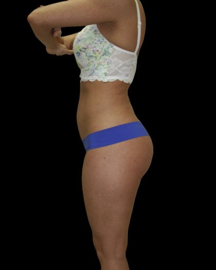 Liposuction Female Before & After Patient #2739
