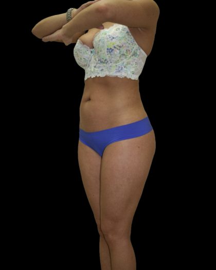 Liposuction Female Before & After Patient #2739