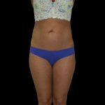 Liposuction Female Before & After Patient #2739