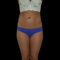 Liposuction Female Before & After Patient #2739