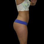 Liposuction Female Before & After Patient #2739