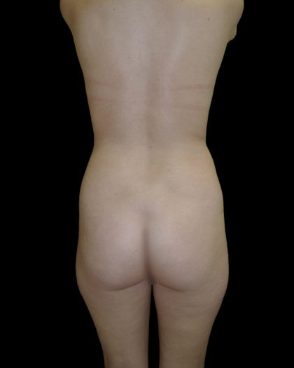 Liposuction Female Before & After Patient #2739