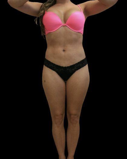 Liposuction Female Before & After Patient #2740