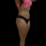 Liposuction Female Before & After Patient #2740