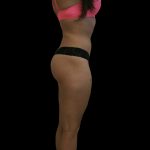 Liposuction Female Before & After Patient #2740