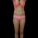 Liposuction Female Before & After Patient #2741
