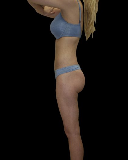 Liposuction Female Before & After Patient #2741