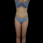 Liposuction Female Before & After Patient #2741