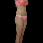 Liposuction Female Before & After Patient #2741