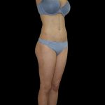 Liposuction Female Before & After Patient #2741