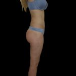 Liposuction Female Before & After Patient #2741