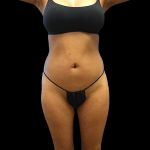 Liposuction Female Before & After Patient #2742