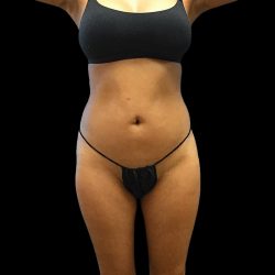 Liposuction Female Before & After Patient #2742