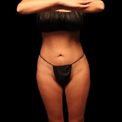 Liposuction Female Before & After Patient #2742