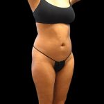 Liposuction Female Before & After Patient #2742