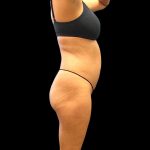 Liposuction Female Before & After Patient #2742