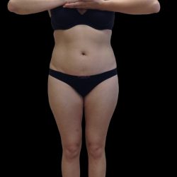 Liposuction Female Before & After Patient #2743