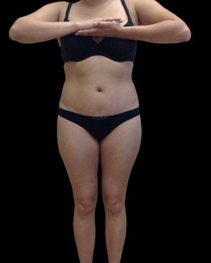 Liposuction Female Before & After Patient #2743
