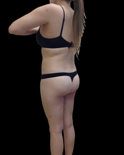 Liposuction Female Before & After Patient #2743
