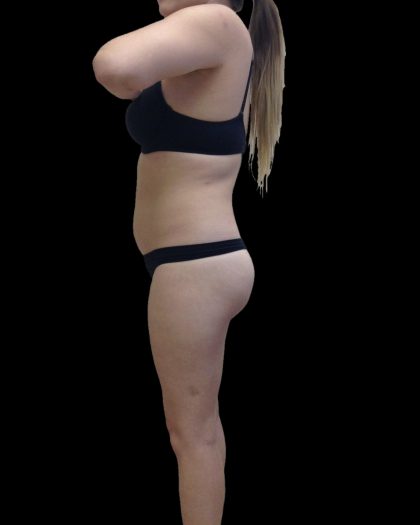 Liposuction Female Before & After Patient #2743